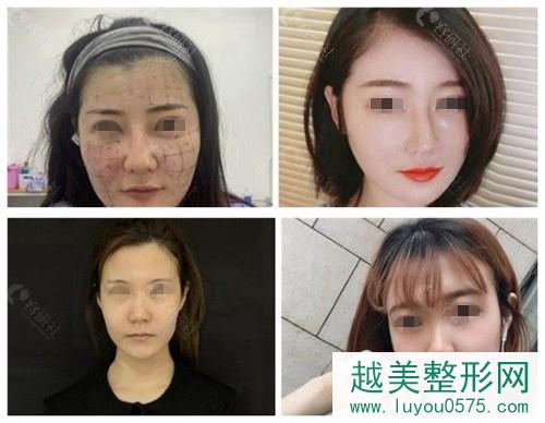 北京华韩医疗柳民熙小切口拉皮手术前后对比照片