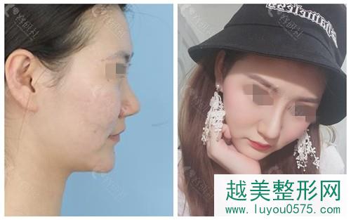 台州艺星鼻部手术案例