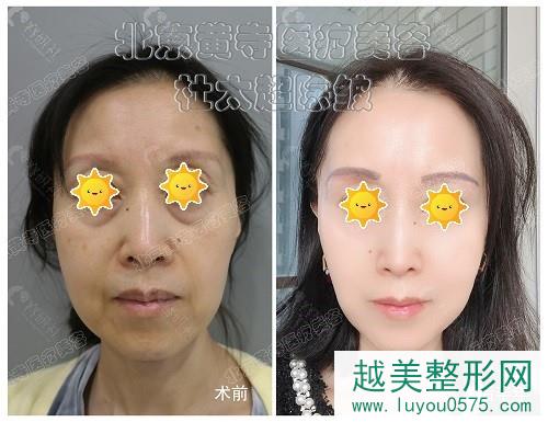 北京黄寺医疗美容医院杜太超CAW除皱案例