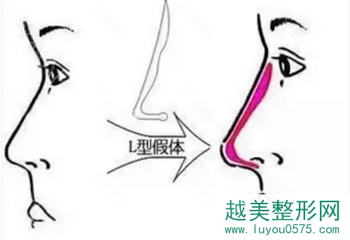 硅胶L型假体也是朝天鼻形成的原因