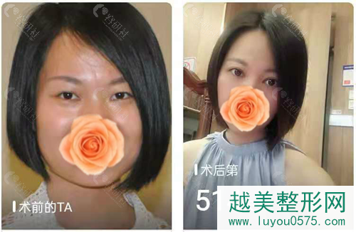 深圳富华医疗美容医院割双眼皮案例