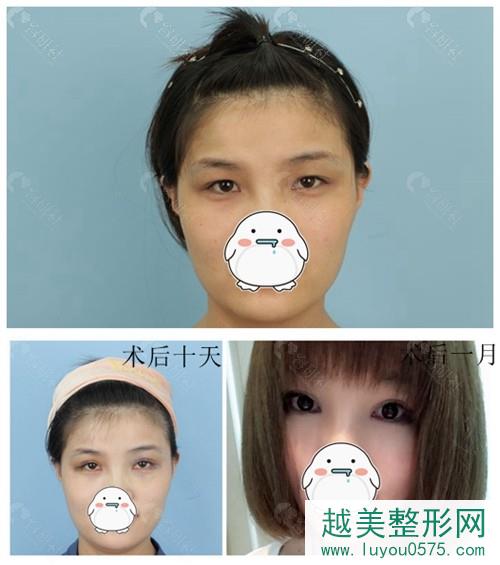 济南艺星医疗美容医院做双眼皮案例前后对比