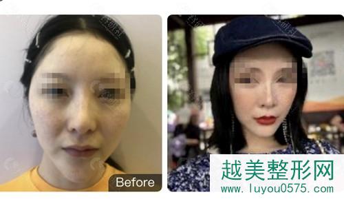 杭州珠儿丽医疗美容诊所真人鼻基底填充对比图