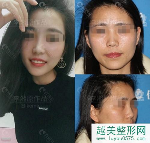上海伊莱美下颌角手术案例