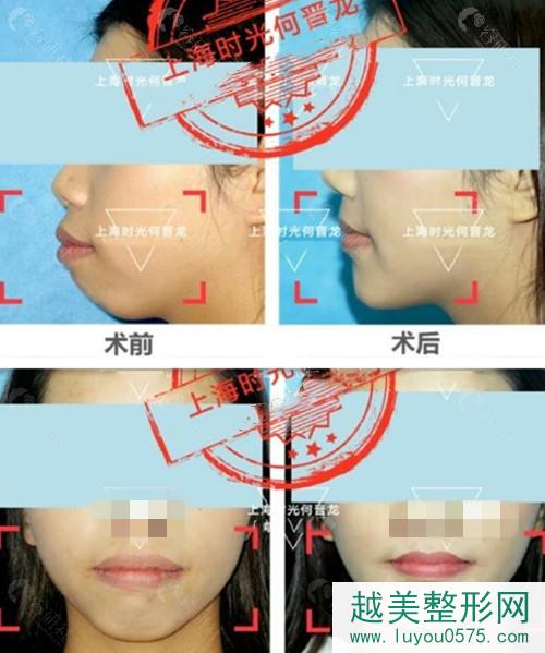 上海时光何晋龙骨性龅牙正颌手术前后对比图