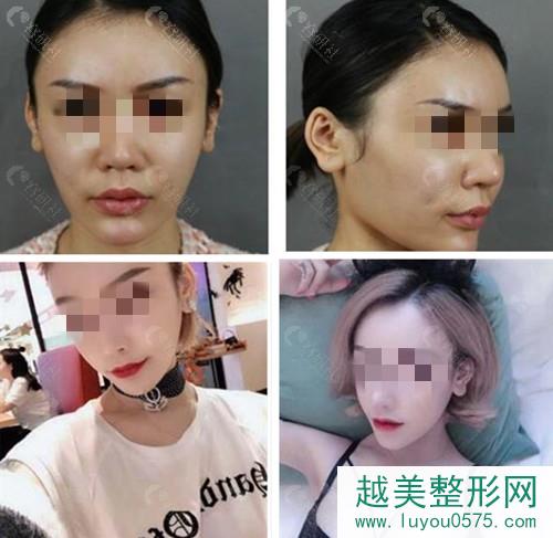 上海首尔丽格石润正颌手术真人案例