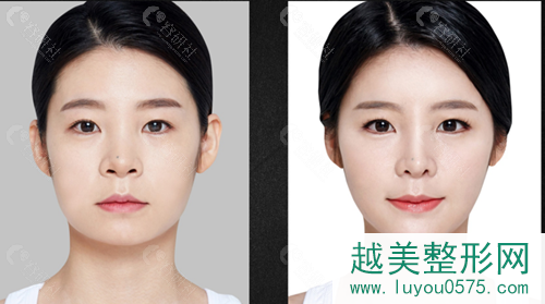 在韩国必当归打注射瘦脸前后对比照片