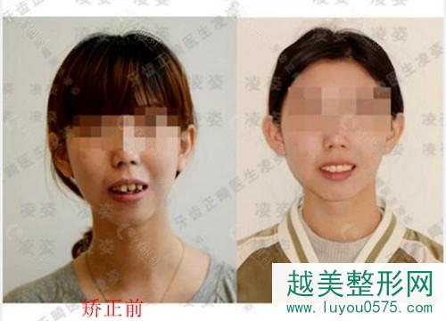 上海圣贝口腔医院牙齿矫正真人案例前后对比图
