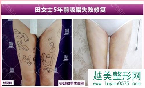 北京达美如艺谷廷敏5年前吸脂失败修复手术案例