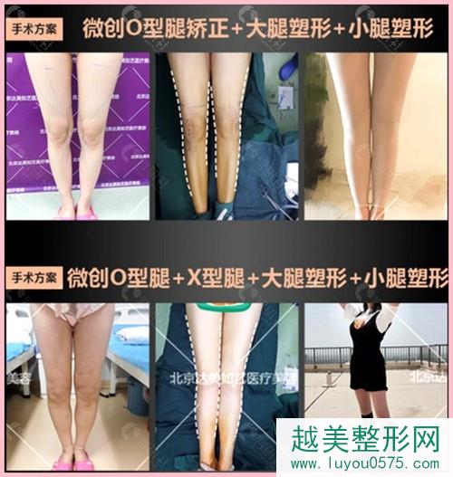 北京达美如艺谷廷敏院长O型、X型腿矫正案例