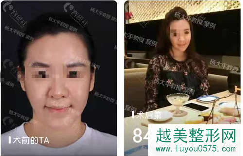 北京联合丽格医疗美容拉皮手术案例