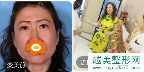 北京加减美整形美容拉皮手术案例