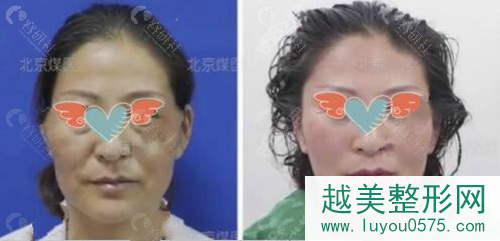 北京煤医医疗美容医院拉皮手术案例