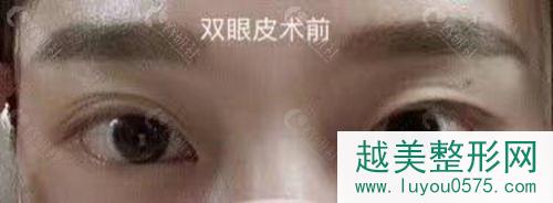 北京联合丽格医院双眼皮术前