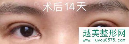 北京联合丽格医院双眼皮术后14天