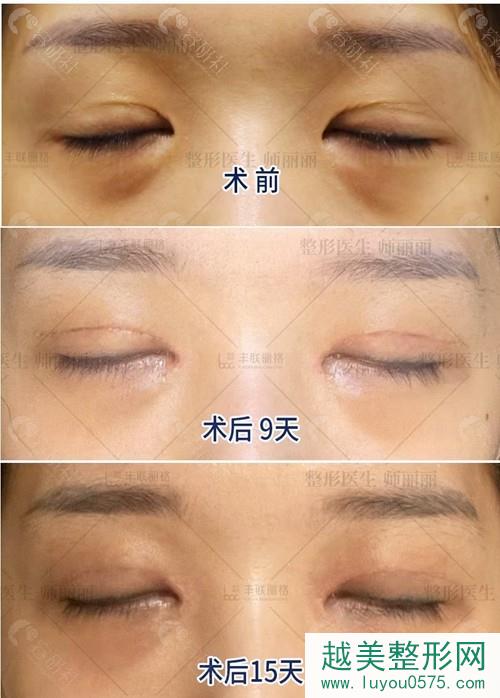 北京丰联丽格师丽丽医生双眼皮修复案例