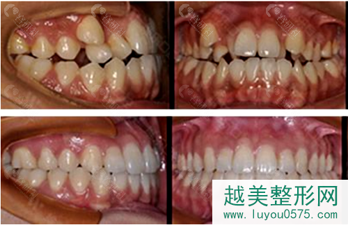 上海浦东新区排名前十牙科医院做的牙齿矫正案例对比图