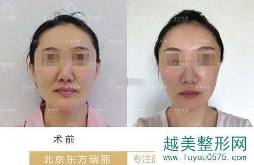 北京东方瑞丽拉皮手术案例