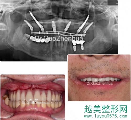 上海鼎植永博口腔高振华种植牙案例