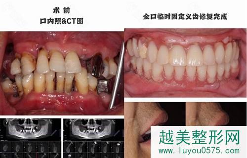 杭州口腔医院种植牙案例