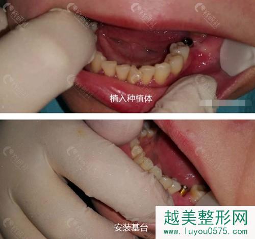 杭州雅莱口腔种植牙过程