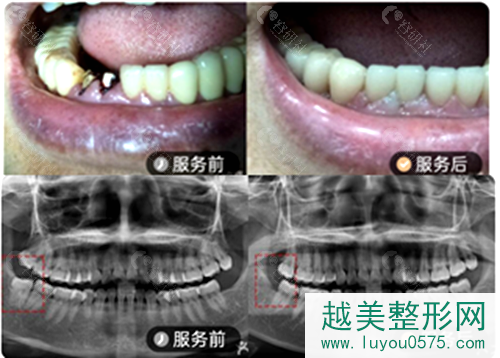 长春超龙牙博士口腔牙齿修复案例