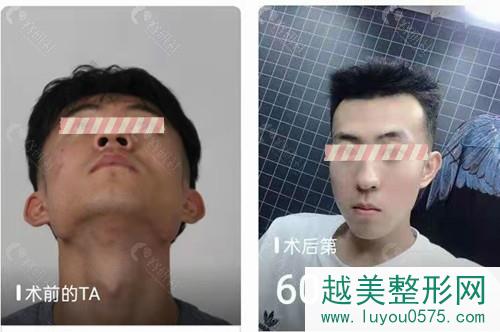 上海愉悦美联臣医疗美容医院下颌角磨骨案例