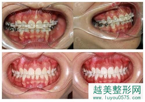 深圳格伦菲尔口腔牙齿矫正、牙齿美白案例