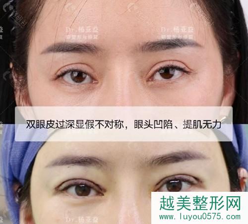 上海华美双眼皮修复案例