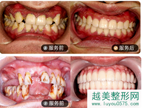 南京值德口腔牙齿矫正和种植牙案例