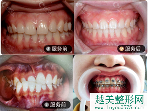 南京康美口腔牙齿矫正案例