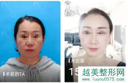 北京京韩医疗美容医院柳民熙拉皮案例