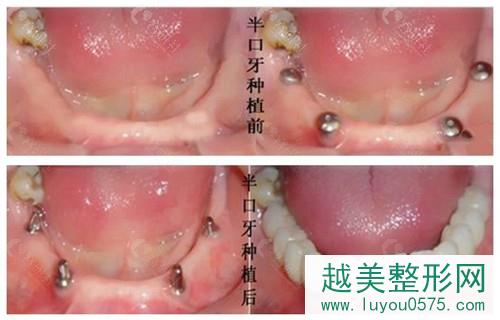 南京美奥口腔半口种植牙案例前后对比