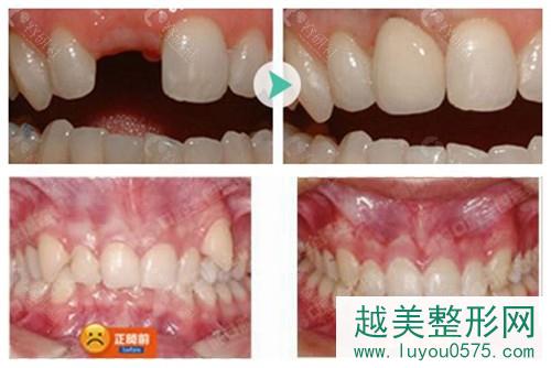 南京博韵口腔牙齿矫正和种植牙案例分享