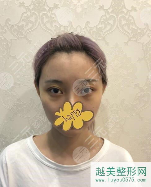 上海九院美容整形科割双眼皮后半个月