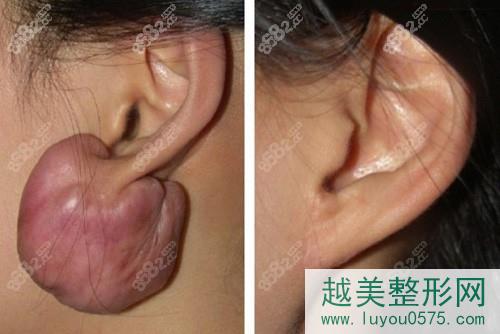韩国安成烈整形外科耳下疤痕修复案例