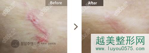 韩国清潭珠颜美容医院疤痕治疗修复前后对比