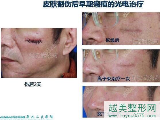 上海九院疤痕修复对比照