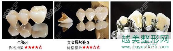 广州烤瓷牙修复图.jpg