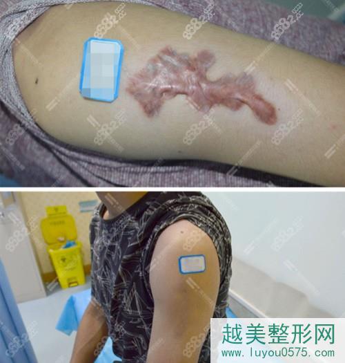 深圳鹏程医院祛疤案例对比
