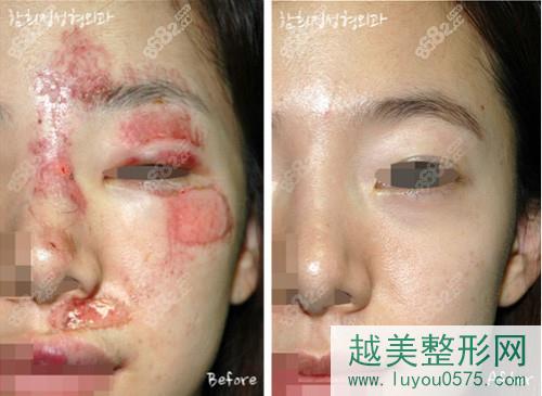 韩国Dr.ham's整形医院烧伤疤痕修复案例对比
