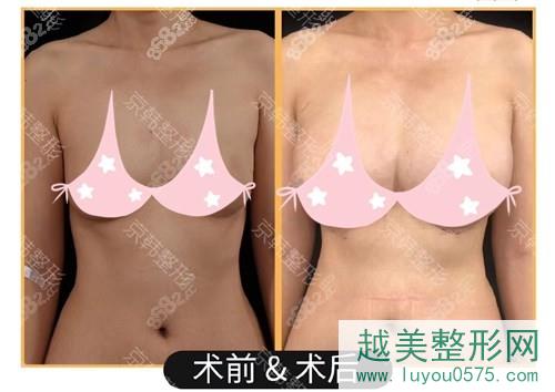 王培森自体脂肪隆胸案例