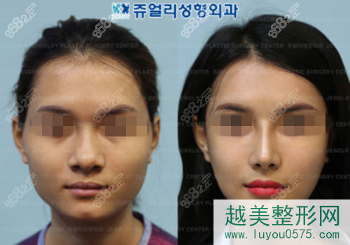 韩国珠儿丽整形医院鼻翼肥大整形案例