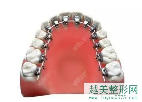 在北京做牙齿舌侧矫正大概要多少钱