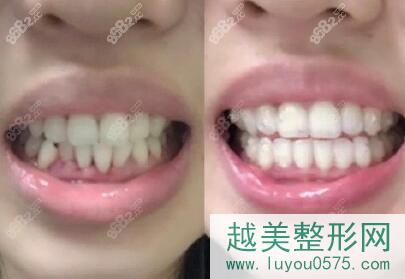 上海九院口腔科牙齿不齐矫正案例照片