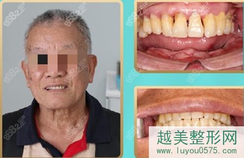 武汉五洲口腔牙齿种植案例