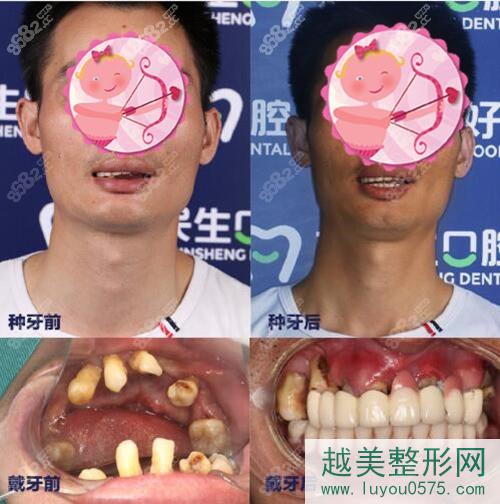 中山种植牙案例