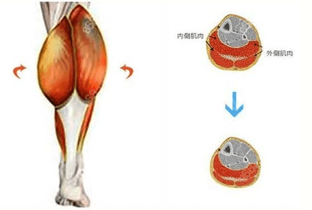 李沁奕神经显微瘦小腿结合腿部肌肉分布示实施手术示意图