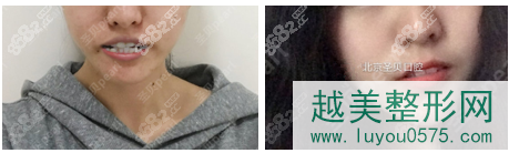 北京圣贝口腔隐形陶瓷托槽牙齿矫正案例
