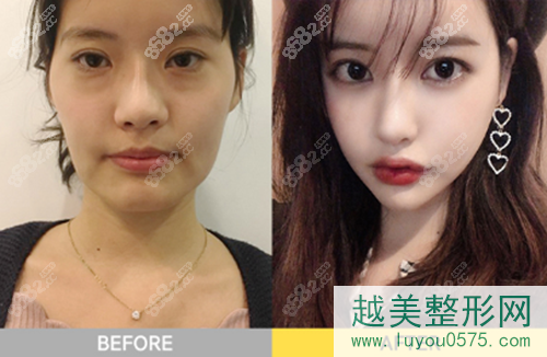 韩国珠儿丽整形外科医院面部轮廓+鼻部整形案例